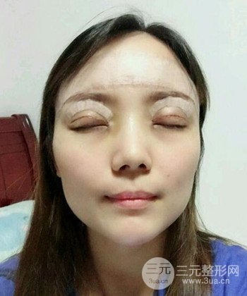 雙眼皮失敗修復(fù)手術(shù)日記分享，改變雙眼皮不對稱