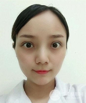 雙眼皮失敗修復(fù)手術(shù)日記分享，改變雙眼皮不對稱