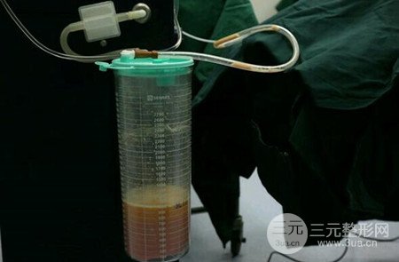 梨型身材做了大腿吸脂之后果超明X，吸脂恢復過程分享