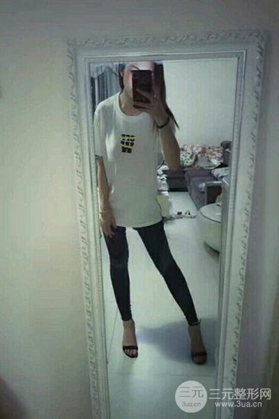 梨型身材做了大腿吸脂之后果超明X,吸脂恢復過程分享