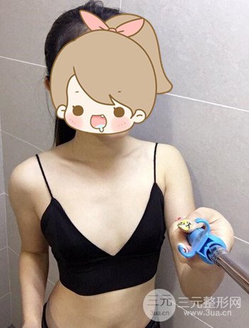 北京自體脂肪隆胸手術(shù)日記分享，豐胸術(shù)后恢復(fù)果圖