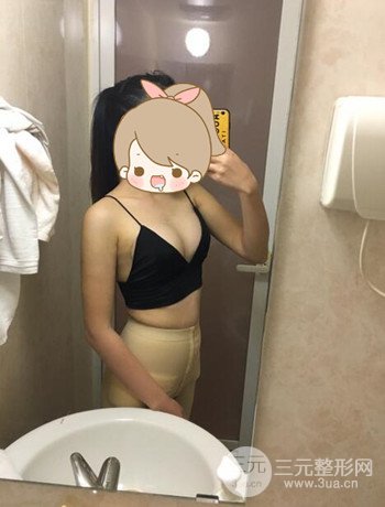 北京自體脂肪隆胸手術(shù)日記分享，豐胸術(shù)后恢復(fù)果圖