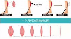 打注射瘦腿要多少錢?注射注射瘦腿的價格?