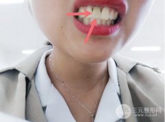 做全口義齒多少錢？制作流程是怎樣的？