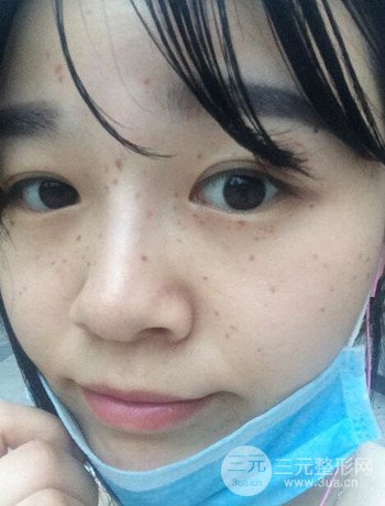 北京激光去雀斑真實(shí)案例分享，純素顏無濾鏡果圖