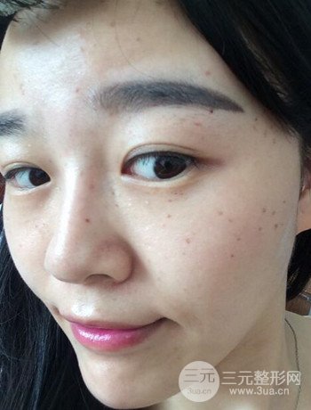 北京激光去雀斑真實(shí)案例分享，純素顏無濾鏡果圖