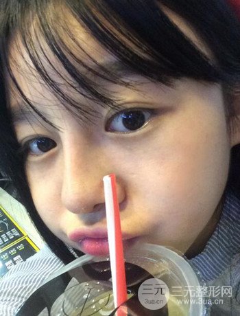 北京激光去雀斑真實(shí)案例分享，純素顏無濾鏡果圖