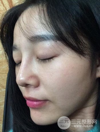 北京激光去雀斑真實(shí)案例分享，純素顏無濾鏡果圖