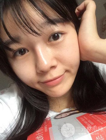 北京激光去雀斑真實(shí)案例分享，純素顏無濾鏡果圖