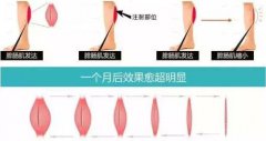 注射瘦腿有嗎?瘦小腿的方法?