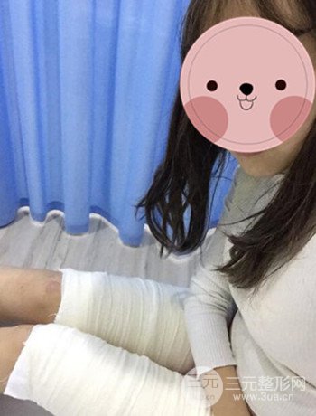 吸脂瘦大腿手術(shù)經(jīng)歷分享，纖細雙腿不再是夢