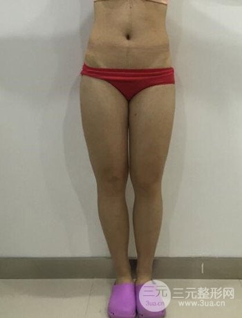 吸脂瘦大腿手術(shù)經(jīng)歷分享，纖細雙腿不再是夢