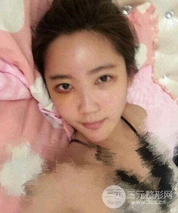 全臉自體脂肪填充手術(shù)日記分享，改良臉型年輕十歲