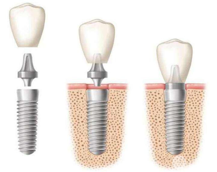奧齒泰種植牙一般要多少錢呢?