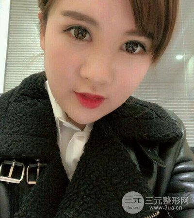 隆鼻整形手術(shù)個人經(jīng)歷分享,精致小翹鼻不是夢