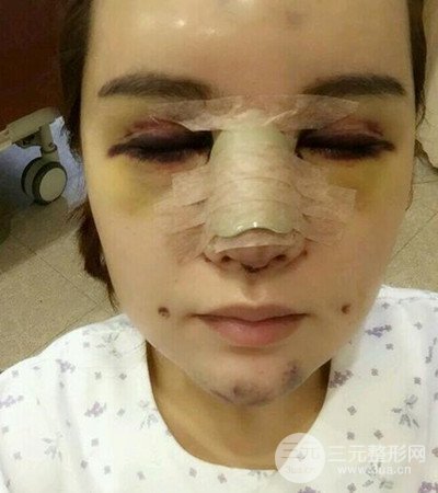 隆鼻整形手術(shù)個人經(jīng)歷分享,精致小翹鼻不是夢