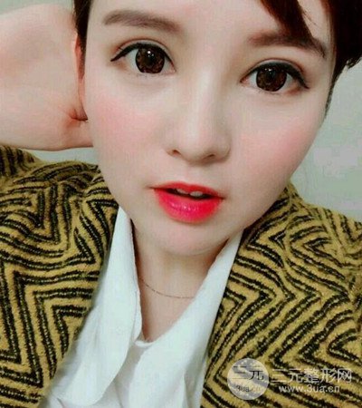 隆鼻整形手術(shù)個人經(jīng)歷分享,精致小翹鼻不是夢