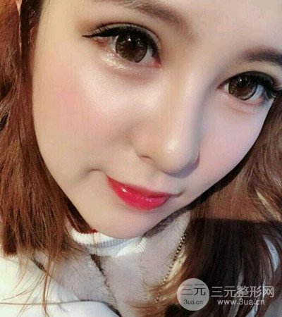 隆鼻整形手術(shù)個人經(jīng)歷分享,精致小翹鼻不是夢