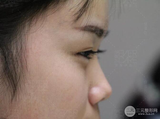 北京伊美爾徐軍假體隆鼻前后對比照片心情日記