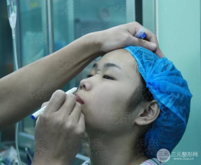 北京伊美爾徐軍假體隆鼻前后對比照片心情日記