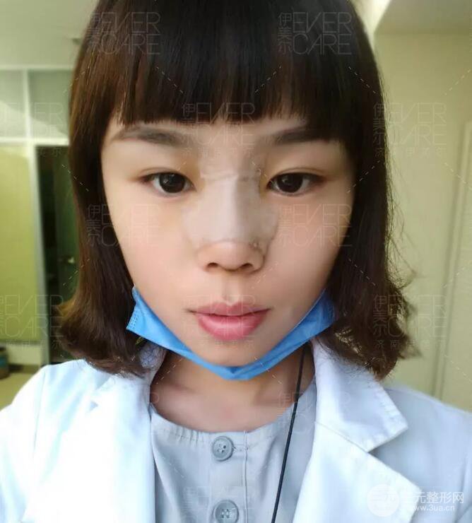 北京伊美爾徐軍假體隆鼻前后對比照片心情日記