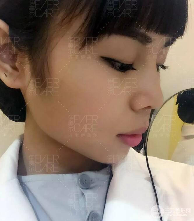 北京伊美爾徐軍假體隆鼻前后對比照片心情日記