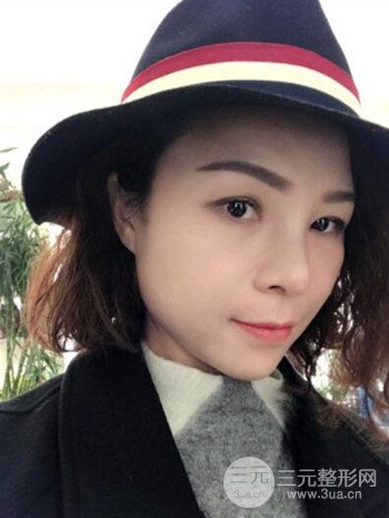 隆鼻整形手術(shù)真人案例恢復(fù)過(guò)程分享 附上果圖