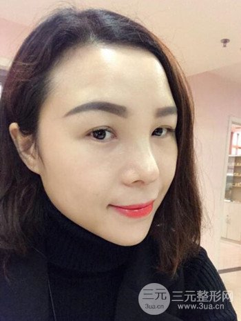 隆鼻整形手術(shù)真人案例恢復(fù)過(guò)程分享 附上果圖