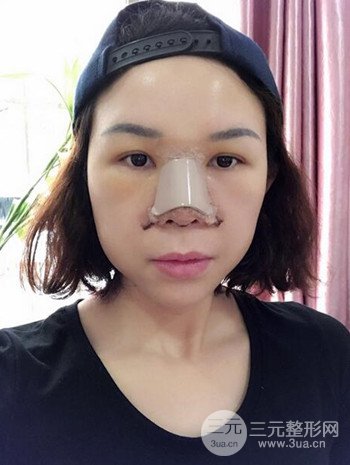 隆鼻整形手術(shù)真人案例恢復(fù)過(guò)程分享 附上果圖