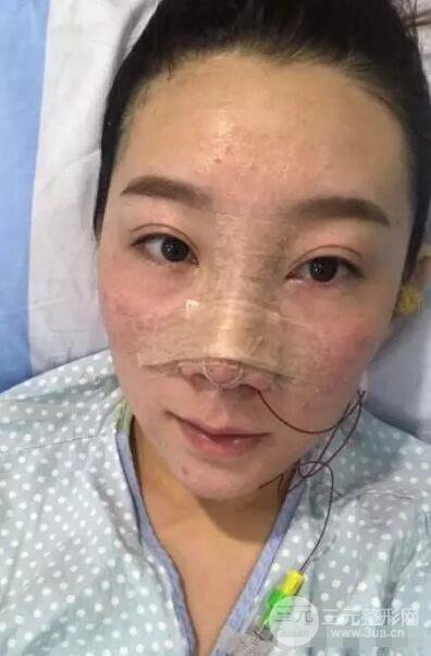 北京伊美爾徐軍隆鼻整形前后對(duì)比照片心情記錄小札