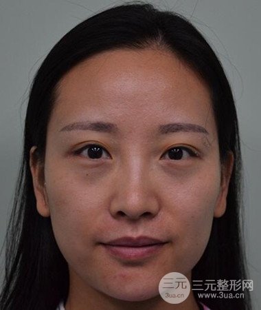 內(nèi)切微創(chuàng)去眼袋手術(shù)案例分享，附上手術(shù)恢復(fù)照片