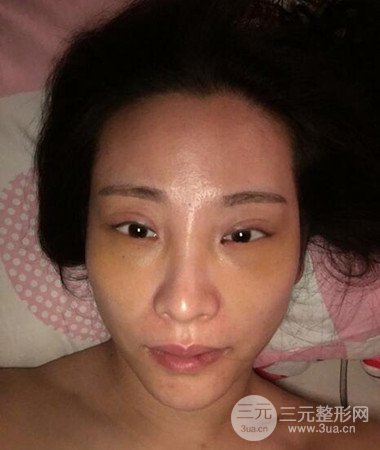 內(nèi)切微創(chuàng)去眼袋手術(shù)案例分享，附上手術(shù)恢復(fù)照片