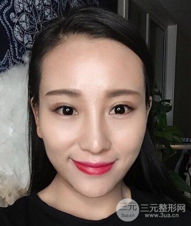 內(nèi)切微創(chuàng)去眼袋手術(shù)案例分享，附上手術(shù)恢復(fù)照片