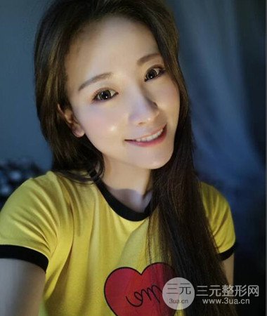 內(nèi)切微創(chuàng)去眼袋手術(shù)案例分享，附上手術(shù)恢復(fù)照片