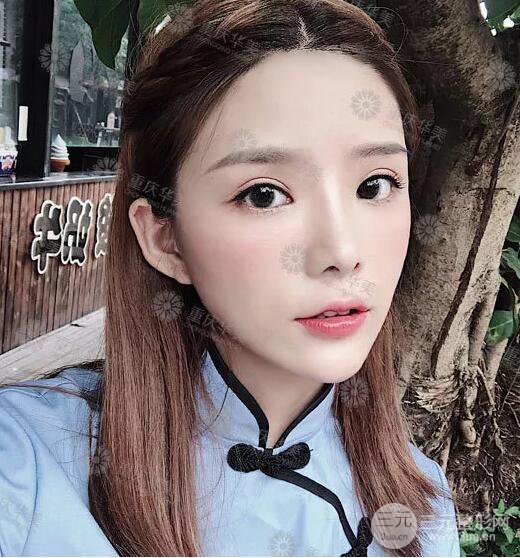 重慶萬州華美雙眼皮+內眼角