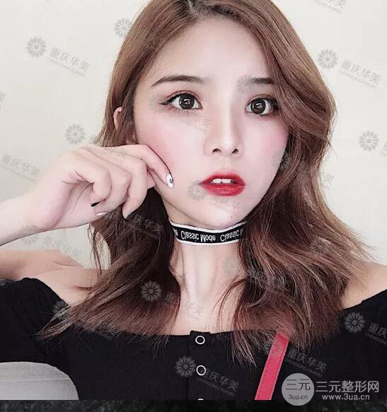 重慶萬州華美雙眼皮+內眼角