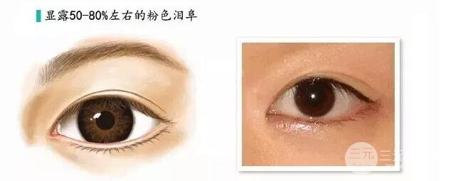 重慶萬州華美雙眼皮+內眼角