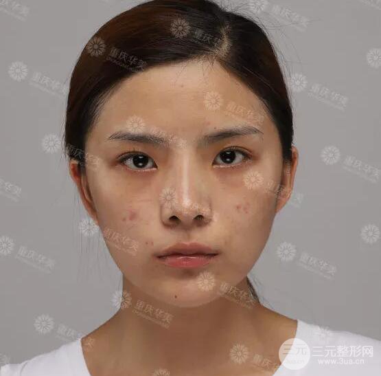 重慶萬州華美雙眼皮+內眼角