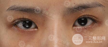 重慶萬州華美雙眼皮+內眼角