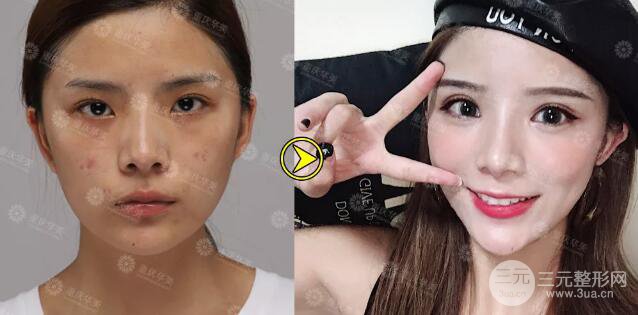 重慶萬州華美雙眼皮+內眼角