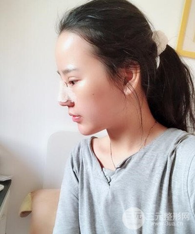 做了隆鼻整形成功落實精致小巧鼻 附上果圖