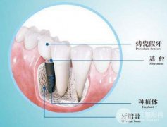 種植牙的使用壽命有多久?