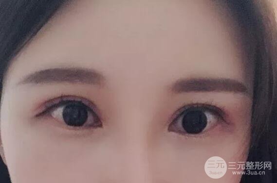蘭大二院張選奮怎么樣?雙眼皮修復(fù)案例前后對比圖