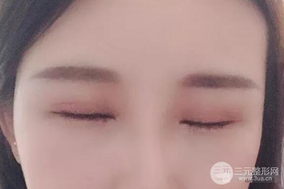 蘭大二院張選奮怎么樣?雙眼皮修復(fù)案例前后對比圖