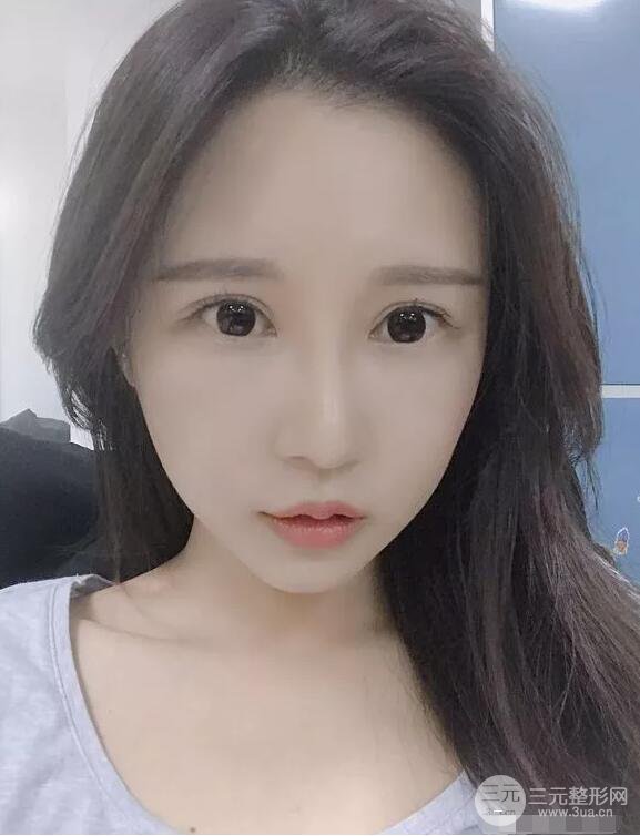 蘭大二院張選奮怎么樣?雙眼皮修復(fù)案例前后對比圖