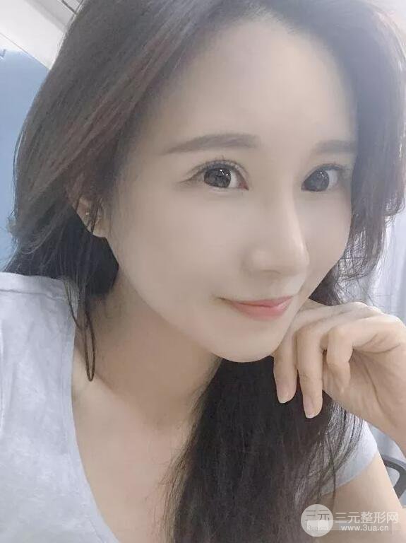 蘭大二院張選奮怎么樣?雙眼皮修復(fù)案例前后對比圖