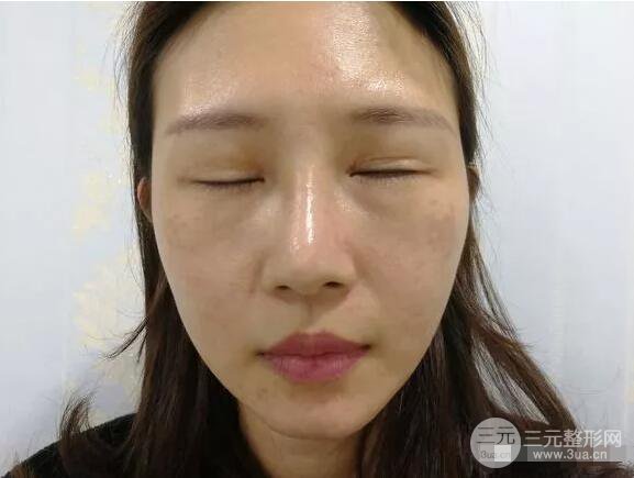 蘭大二院張選奮怎么樣?雙眼皮修復(fù)案例前后對比圖