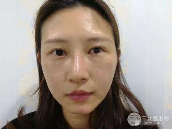 蘭大二院張選奮怎么樣?雙眼皮修復(fù)案例前后對比圖