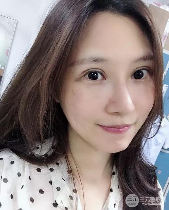 蘭大二院張選奮怎么樣?雙眼皮修復(fù)案例前后對比圖