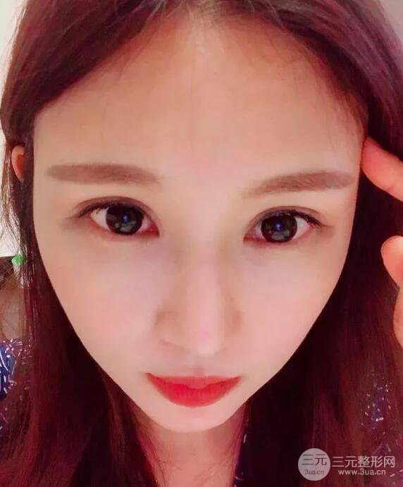 蘭大二院張選奮怎么樣?雙眼皮修復(fù)案例前后對比圖